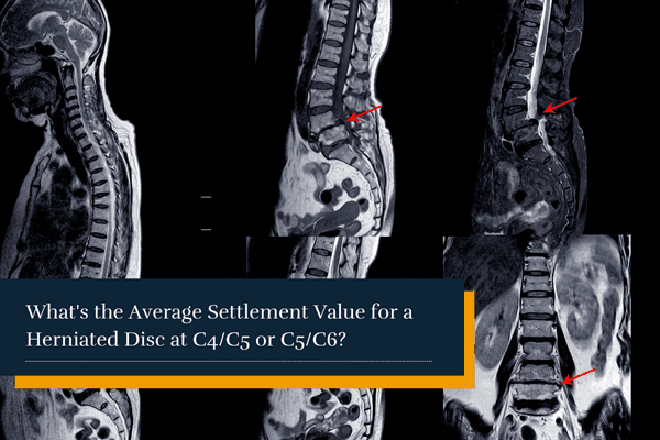 X-Ray of spinal cord compression at C4-5 and C5-6